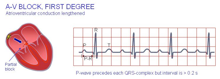constant then a QRS is dropped 3rd degree: No discernable relationship between p waves and QRS complexes The right