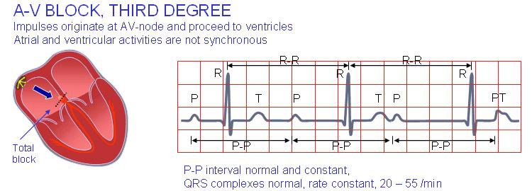 activation reaches the right ventricle by proceeding from the left ventricle.
