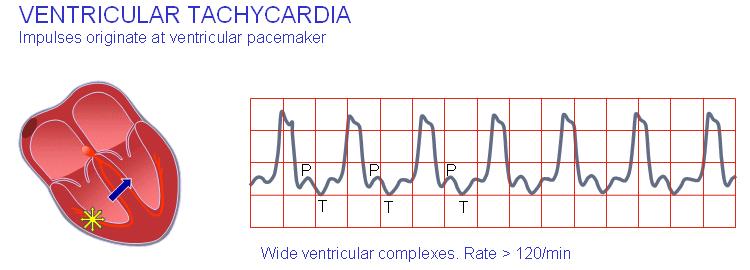 Usually the P-wave is not associated with it.