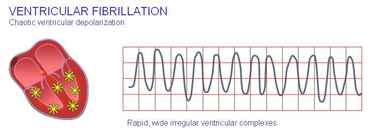SZÍVINFARKTUS When ventricular depolarization occurs chaotically, the situation is called ventricular fibrillation.