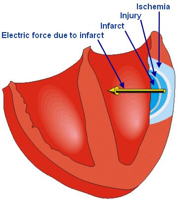 The cause of fibrillation is the establishment of multiple re-entry loops usually involving diseased heart muscle.