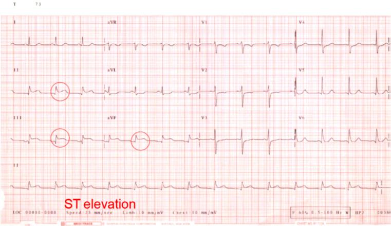 MYOCARDIAL ISCHEMIA AND INFARCTION If a coronary artery is occluded, the transport of oxygen to the cardiac muscle is decreased, causing an oxygen debt in the muscle, which is