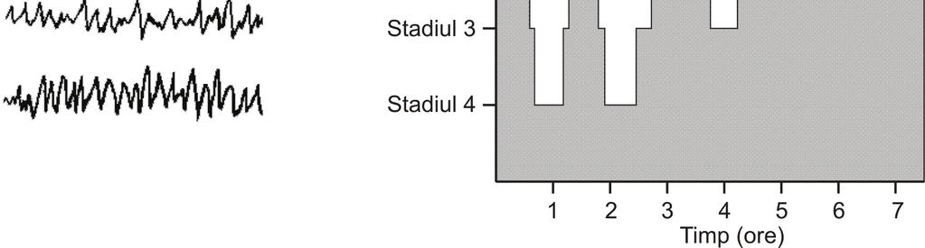 Electroencefalografia 53 (asocierea dintre un vârf şi o undă amplă, lentă cu durata de 0,2-0,5 sec şi amplitudinea 150-300 μv.