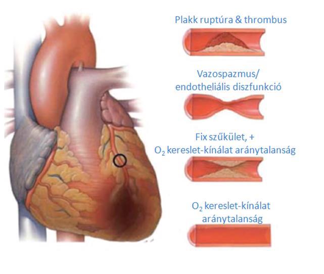 A szívinfarktus kifejezés ischaemiás eredetű szívizom elhalást jelent.