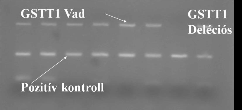 9. ábra: A GSTT1 gén null (deléciós) polimorfizmusát bemutató gélkép, ahol pozitív kontrollként az APOA5 szerepel A képeken látható, hogy a GSTM1 és GSTT1 gének esetében a vad homozigóta és