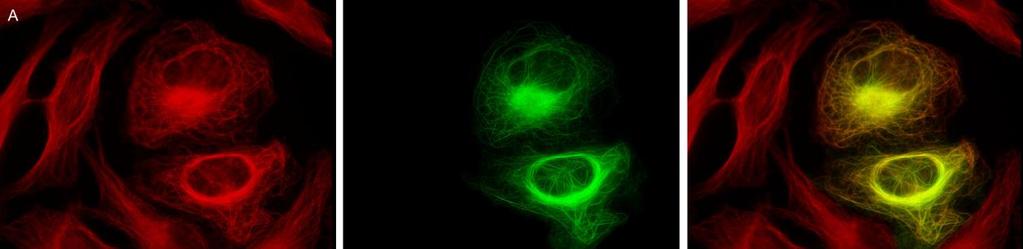 képlet, a csomó kialakul, a sejtperiférián nem maradnak mikrotubulusok, vagy sajátos kiürülés jellemző a citoszolra, a mikrotubulus szálak ritkábban, vizuálisan vastagabban, és tovább nyúlva