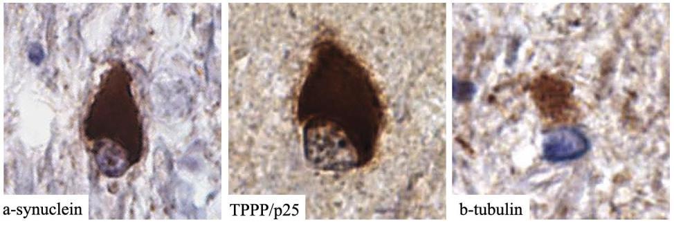 Továbbá, a jelölés specifikus szinukleinopátiákra; Alzheimer-kórban és más tauopátiák esetén a TPPP/p25 immunpozitivitás nem volt kimutatható.