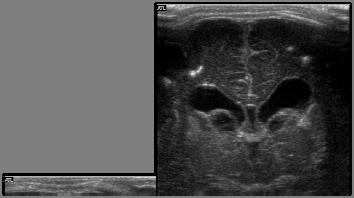 Legfontosabb kórokozók: Toxoplasma Rubeola CMV HSV 2 Kevésbé jelentősek: Congenital varicella Syphilis HIV Lymphocytás