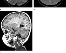 görcsök (10%) IC meszesedések (43%), ventriculomegalia (23%),