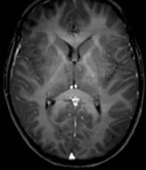 és subcorticalis