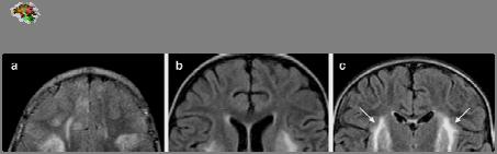 VZV Encephalitis EBV encephalitis Bilateral subcorticalis és cortocalis elváltozások (tip. Virus inf.