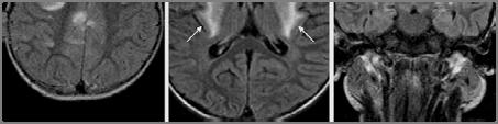 érintettek Agytörzs, cerebellum, myelon 30-50%-ban DWI fokozott diffúziót mutat az acut és subacut fázisban (vasculitisben gátolt