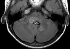 sinusitis) Gyakoriság: az életkor előrehaladtával csökken: kora érett csecsemő gyermekkor felnőtt