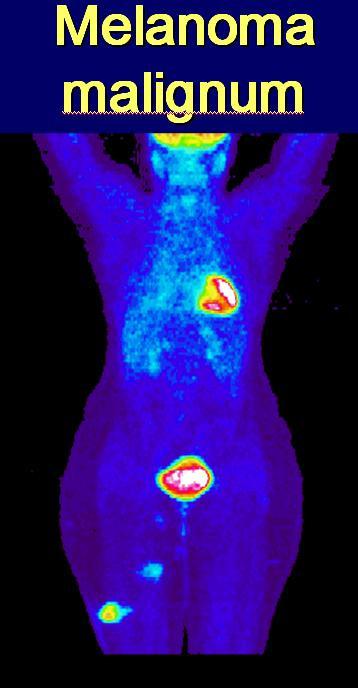 Perfusion tracer O15water Glucose metabolism