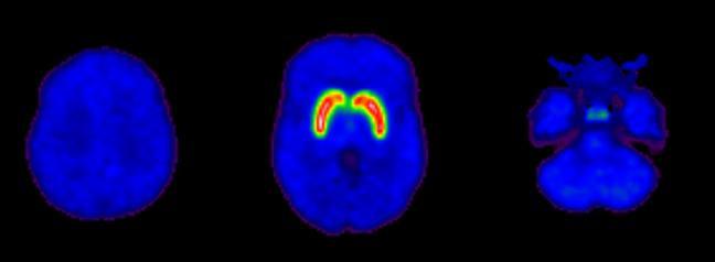 metabolism tracer Low-grade Lowglioma Balkay