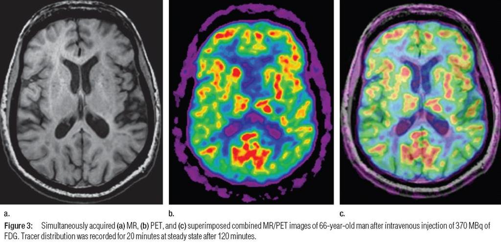 a PET-MRI kamerával FDG agyi halmozási kép egy mai