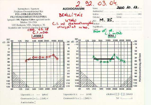 Kétoldali cochlearis implantáció Jobb beszédérthetőség zajban