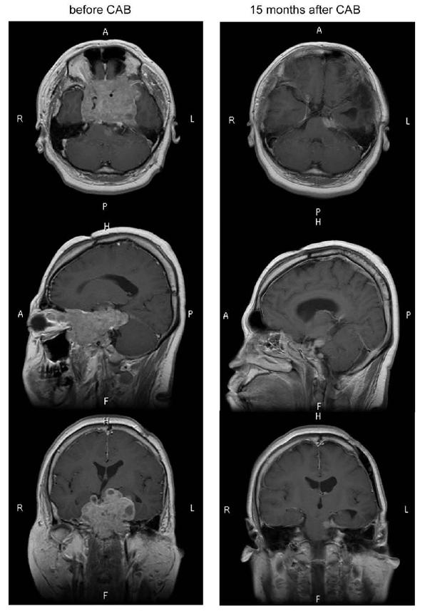 28 éves férfi, 9 éves kora óta ismert prolactinoma, 60 mg/nap bromocriptin kezelés mellett 8 cm-es tumor, prolactin 63 400 ng/ml, amely