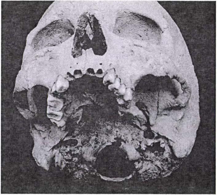 ábra: Osteolyticus és kevert léziók az arcus vertebrae és a processus