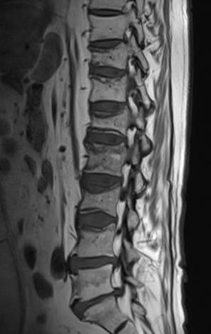 16. ábra T1 súlyozott, sagittalis síkú MR felvétel. Coronalis síkú felvételen diagnosztizált elváltozásokat láthatjuk ezen, a sagittalis síkú képen.