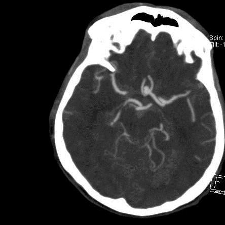 Aneurysma