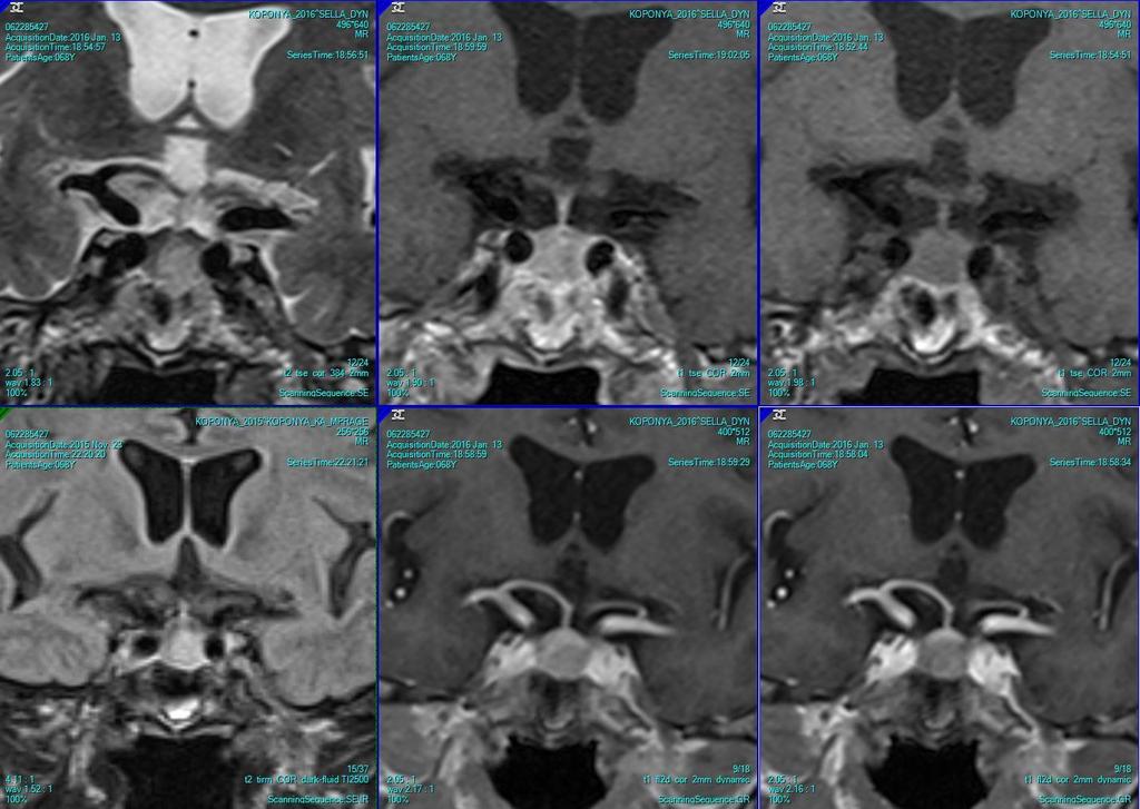 A hypophysis tu.