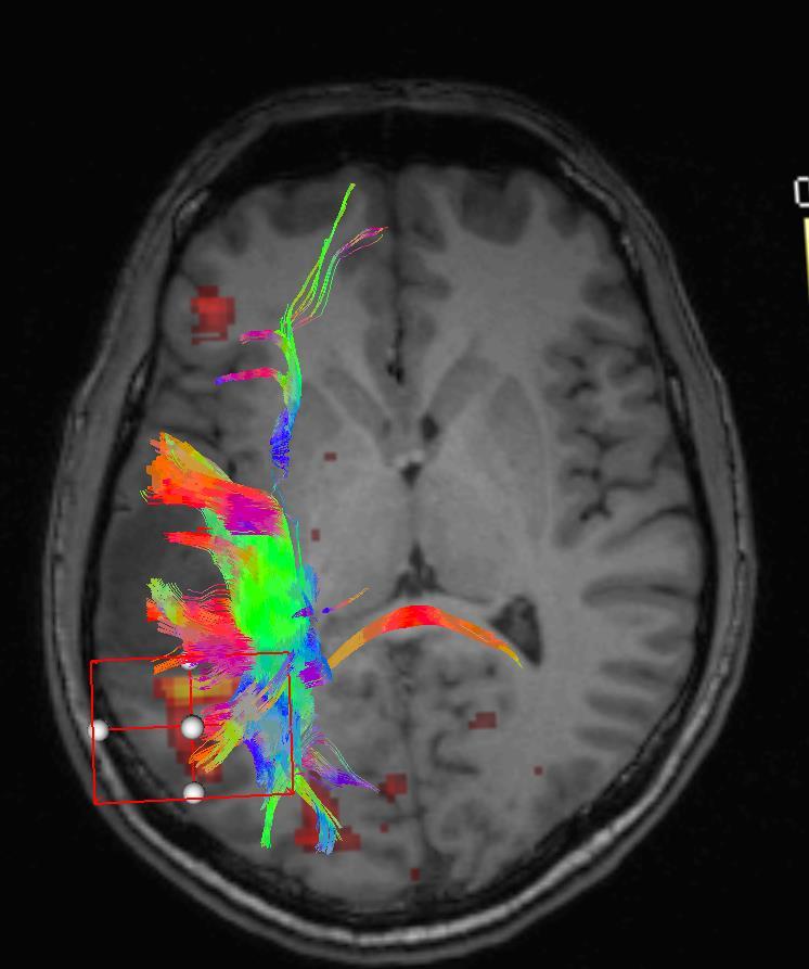 fmri DTI Műtéti