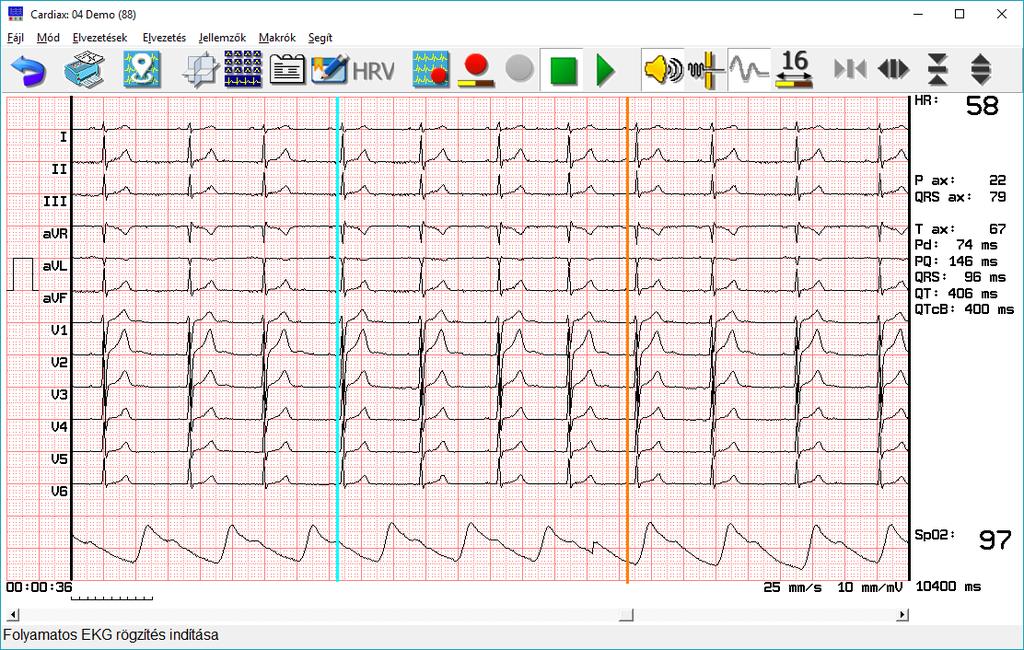 6. Eltárolt EKG felvételek 6.1 EKG-vonalzó (manuális mérés) A görbe a nullvonal-ingadozás korrigálása után jelenik meg a képernyőn.
