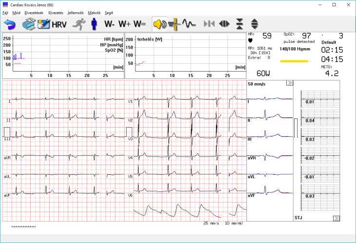 A terheléses EKG monitor Kerékpár esetén: A terheléses EKG monitor Futószalag esetén: A futó görbék fölötti területen