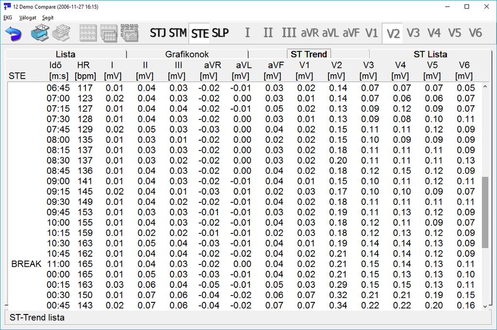 ST-Lista Táblázat, mely a szívfrekvencia és a standard 12 csatorna ST adatait foglalja össze. Az STE, STJ, STM illetve SLP értékek a megfelelő gomb megnyomásával vagy [F5]-tel válthatók.