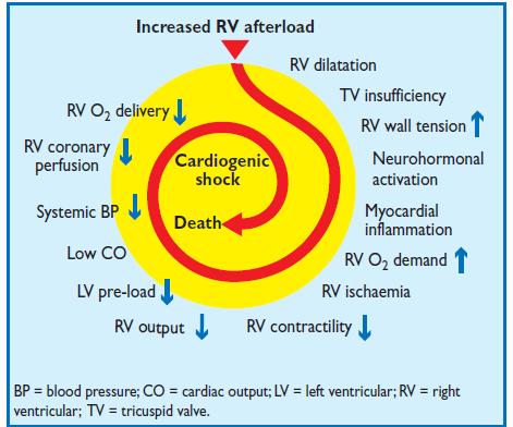 Kórélettan Hemodinamikai következmények: pulmonalis vascularis rezisztencia nő, ezt terhelést (afterload növekedését) a jobb kamra nem bírja (jobb kamra képtelen 40 Hgmm-nél nagyobb nyomást