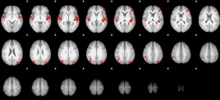 ugyancsak a MFG (BA 6), az IPL, valamint a jobb dorsolateralis prefrontalis cortex (DLPFC) területén találtunk az egészségesekénél szignifikánsan nagyobb aktivációkat.