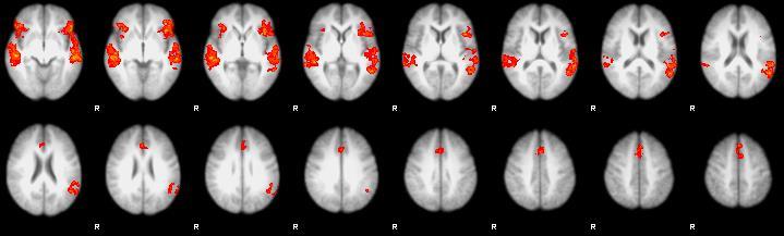 Jobb és bal oldali gyrus temporalis medialis és bal temporalis pólus. A csoportanalízisben Z (T/F Gauss eloszlású) statisztikai képek küszöbölése Z>2.3 cluster, és a P=0.