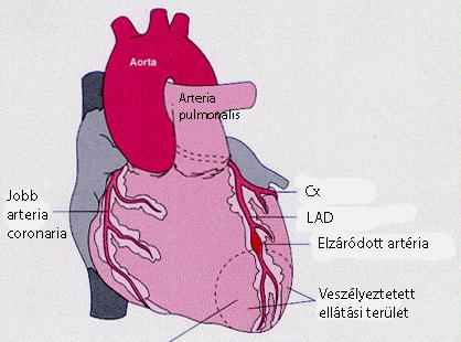 A szívizomperfúzió regionalis romlásának okai Atherosklerotikus plakk + komplikáló tényezők Ritkán