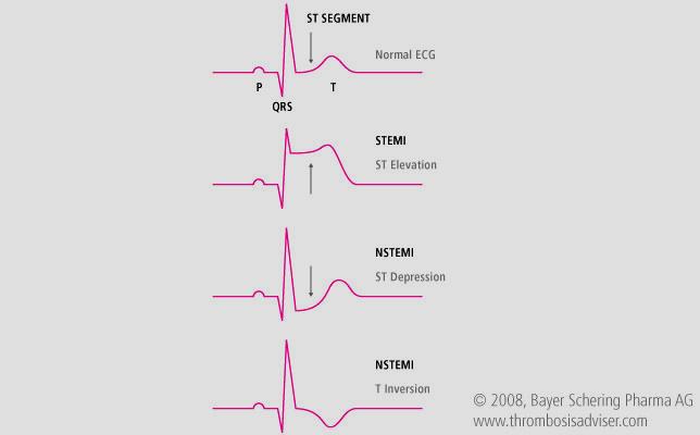 STEMI -