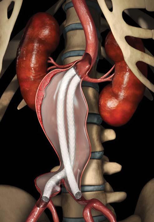 Nellix: új távlatok az aortoiliacalis aneurysmák kezelésében 19 Bevezetés Az első aortastentgraft beültetését követően alapjaiban változott meg az aneurysmák kezelése.