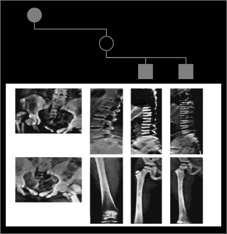 22. ábra A vizsgált személyek családfája és csontröntgen felvételei.