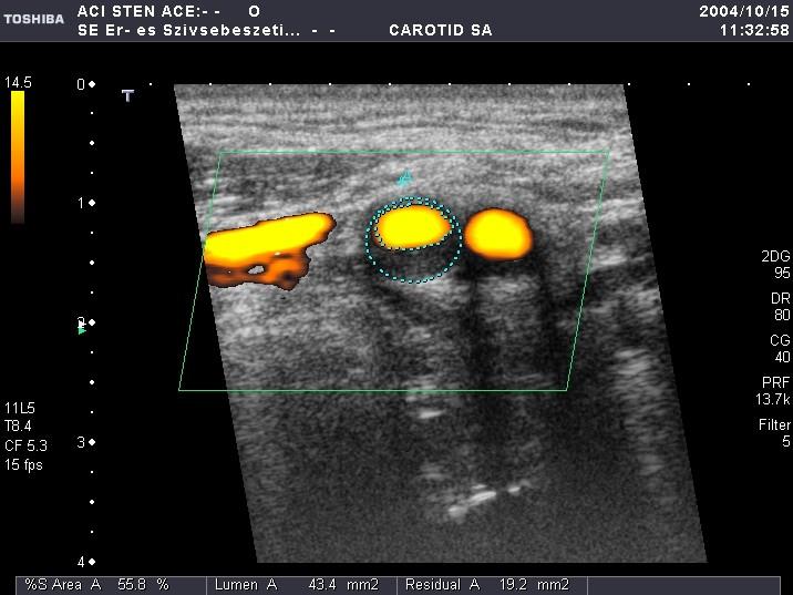 A carotis szűkület meghatározása