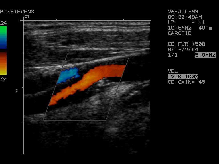 40%ICAstenosis Peaksystolicvelocity 0 20 40 60 80 100 %stenosisindiameter