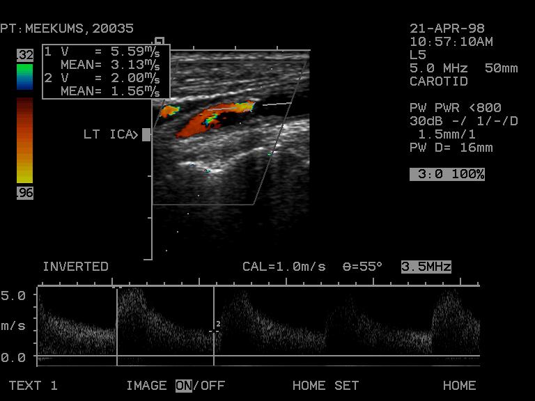 80 90%ICAstenosis Peaksystolicvelocity 0 20 40 60 80 100 %stenosisindiameter