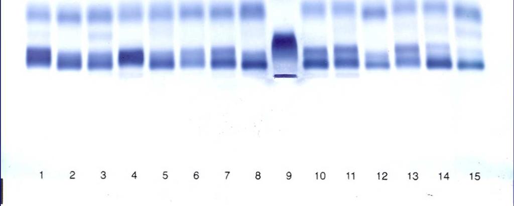 Lipoprotein electroforetogramm és denzitometriás értékelés Alfa: 11,8% Lp(a):