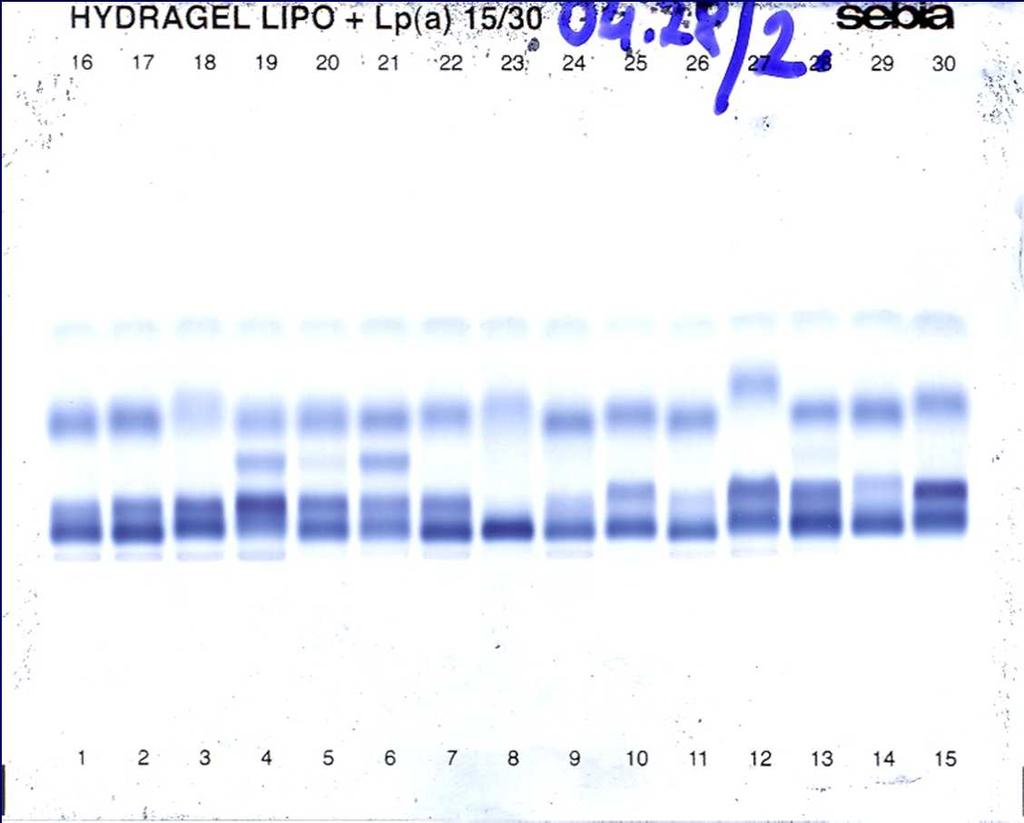 Lipoprotein electroforetogramm és