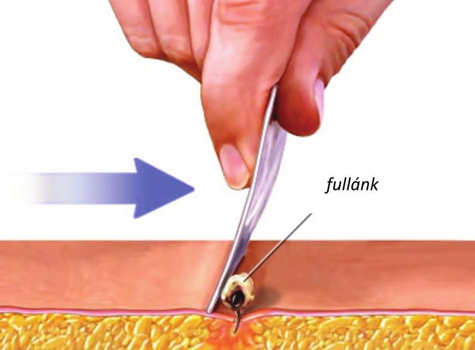 460 GYÓGYSZERÉSZET 2017. augusztus 4. ábra: Bennszakadt fullánk eltávolítása kártyával (http://www.three-peaks.net/uba/allergy.htm) degranulációjához.
