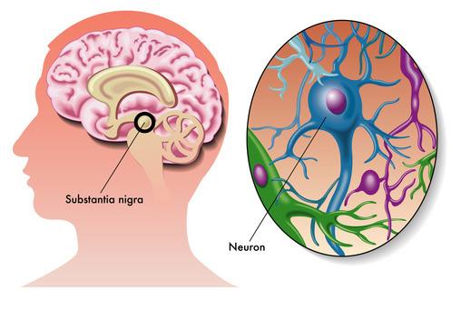 Mi is az a Parkinson-kór? A Parkinson-kór fokozatosan előrehaladó idegrendszeri betegség, aminek az oka nem tisztázott.