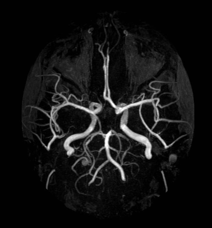 MR-angio Vasculitis (a. cer. ant.) Stenosis (a.