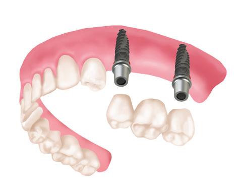 érhető el, mindössze négy implantátum beültetésével. Az ideiglenes fogsor már a műtét napján behelyezhető.