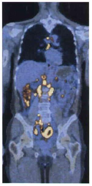 Jóindulatú (benignus) és rosszindulatú (malignus) tumorok tumor=daganat, malignus tumor = rák cső (pl.