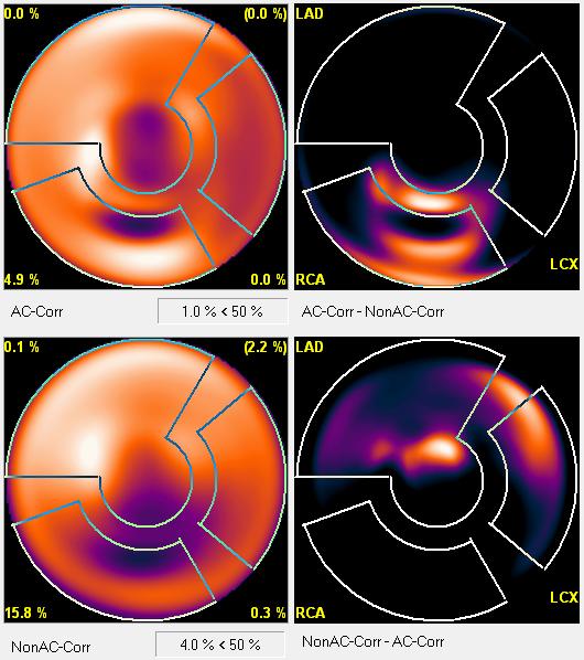 Párhuzamos SPECT rekonstrukció 41 1.22. ábra Biodex Lung-Spine SPECT mellkas fantom rekonstruált képei bullseye megjelenítésben.