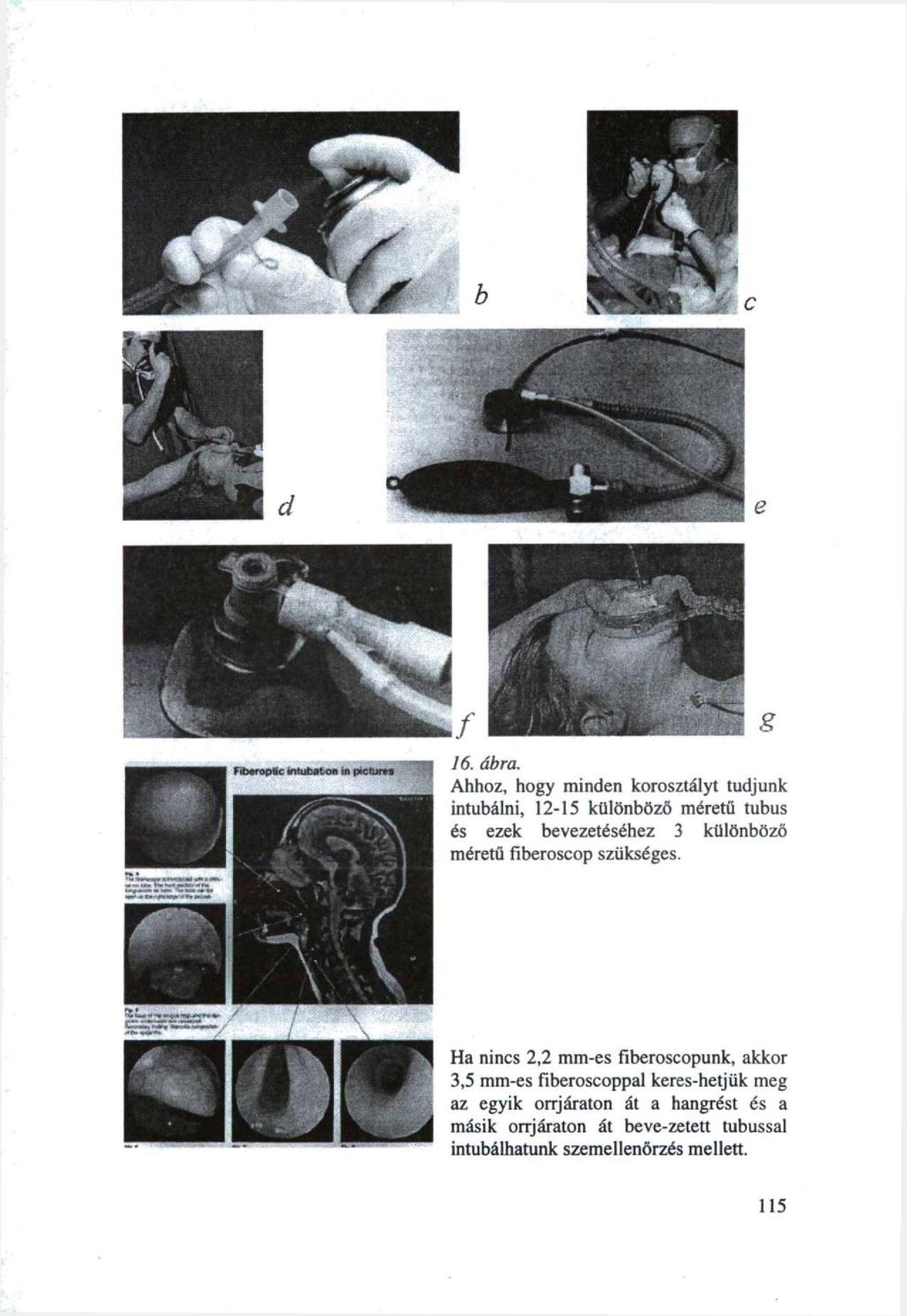 16. ábra. Ahhoz, hogy minden korosztályt tudjunk intubálni, 12-15 különböző méretű tubus és ezek bevezetéséhez 3 különböző méretű Fiberoscop szükséges.