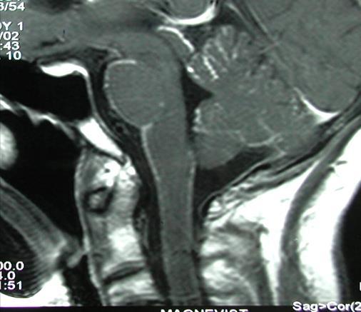 MRI ( 1.5T) előnyei 1.